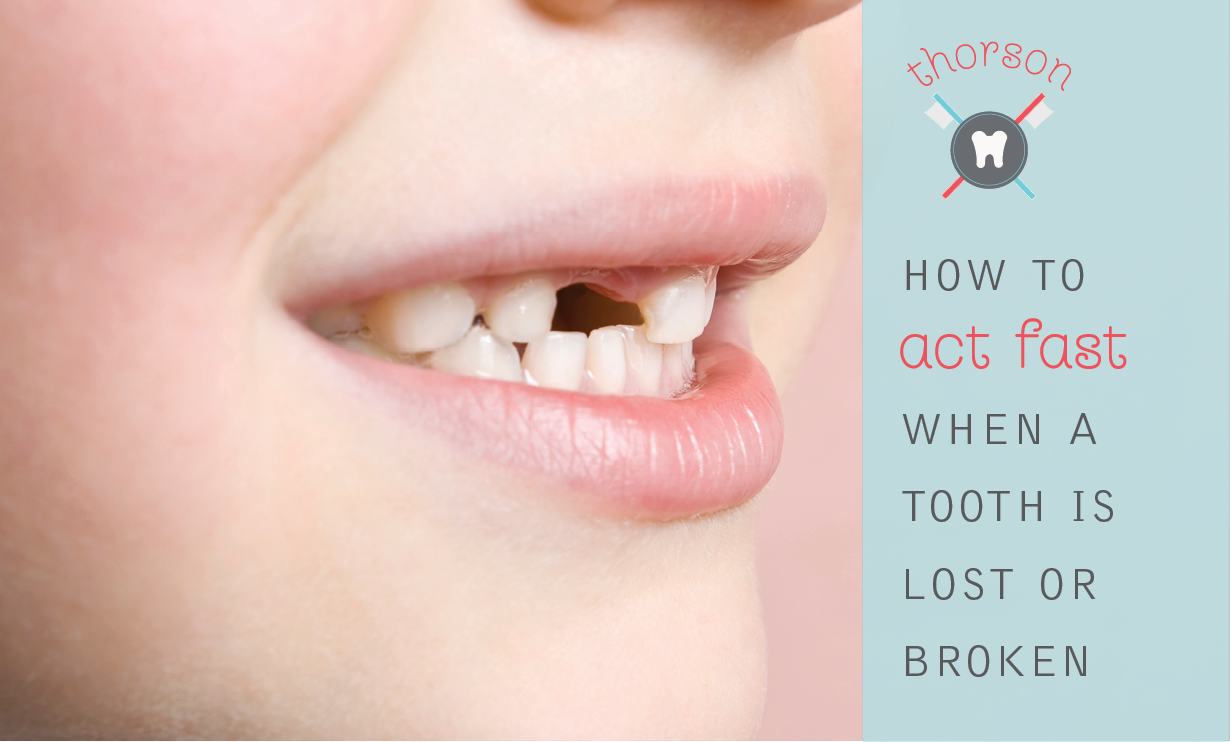 You are currently viewing How To Act Fast When a Tooth Is Lost or Broken